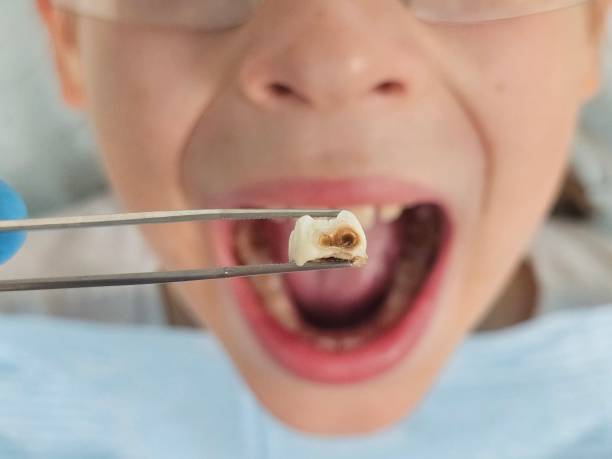 Best Root Canal Emergency Dentist  in Kempner, TX